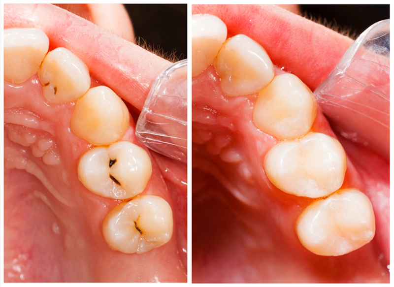 Fillings Clinton Township, MI
